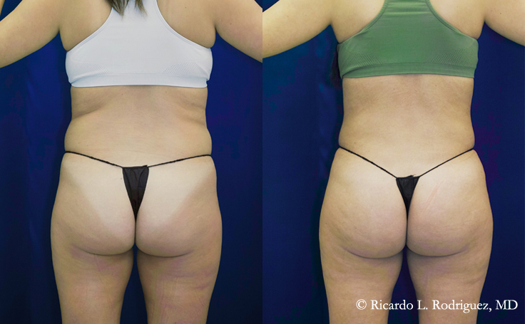 Before and after photo of an actual Brazilian Butt Lift patient.