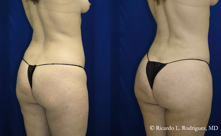 before and after pictures of a brazilian butt lift patient