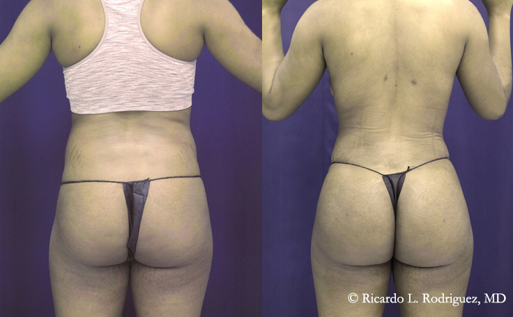 brazilian butt lift patient before and after bbl with lipo 360
