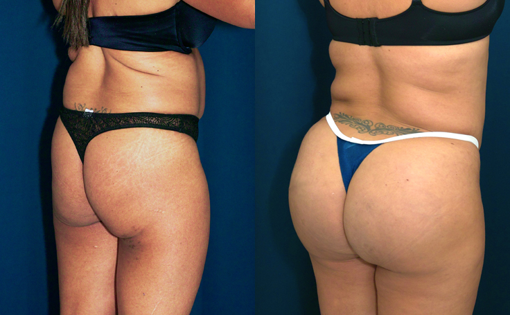 Before and after photo of an actual Brazilian Butt Lift patient.