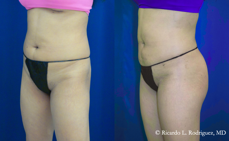 Before and after photo of an actual Brazilian Butt Lift patient.