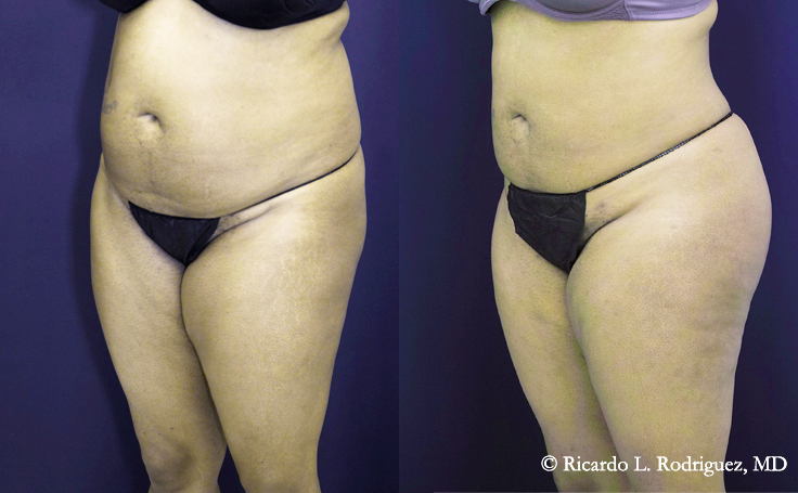 Before and after photo of an actual Brazilian Butt Lift patient.