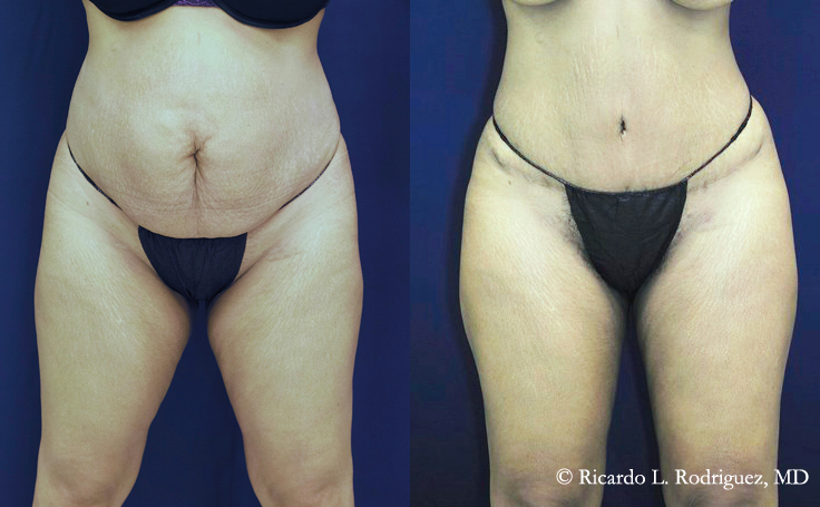 Before and after photo of an actual Brazilian Butt Lift patient.