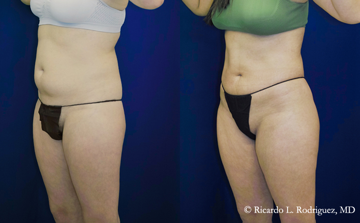 Before and after photo of an actual Brazilian Butt Lift patient.