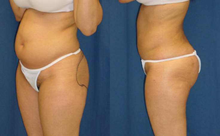 Before and after photo of an actual Brazilian Butt Lift patient.