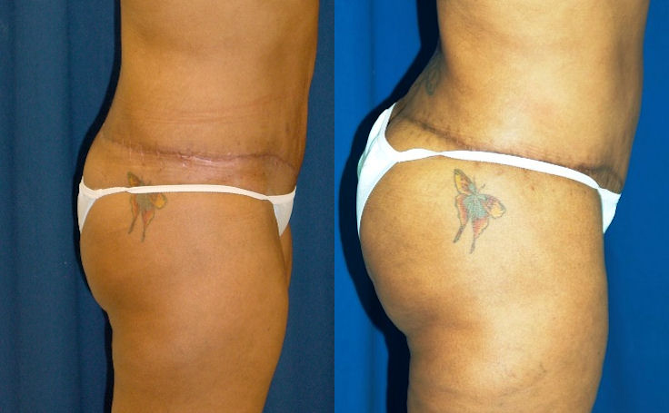 Before and after photo of an actual Brazilian Butt Lift patient.