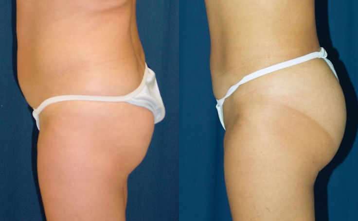 Before and after photo of an actual Brazilian Butt Lift patient.