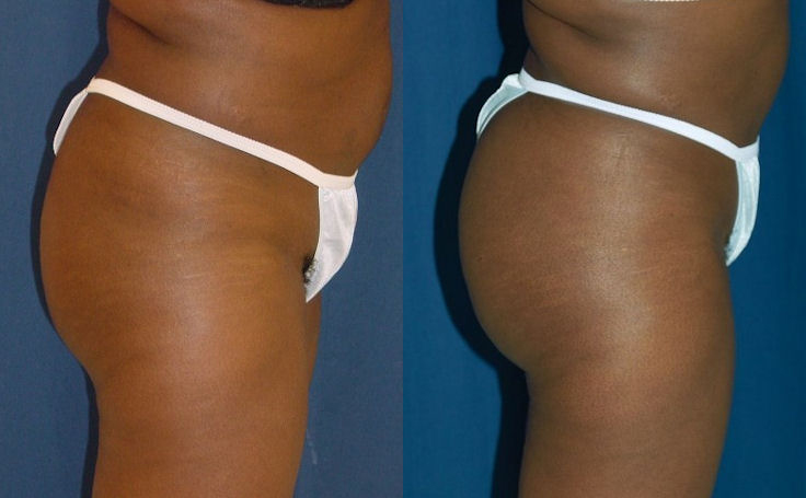 Before and after photo of an actual Brazilian Butt Lift patient.