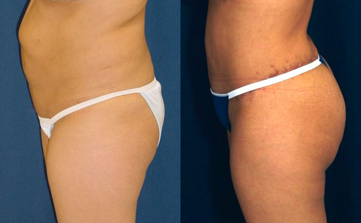 Before and after photo of an actual Brazilian Butt Lift patient.