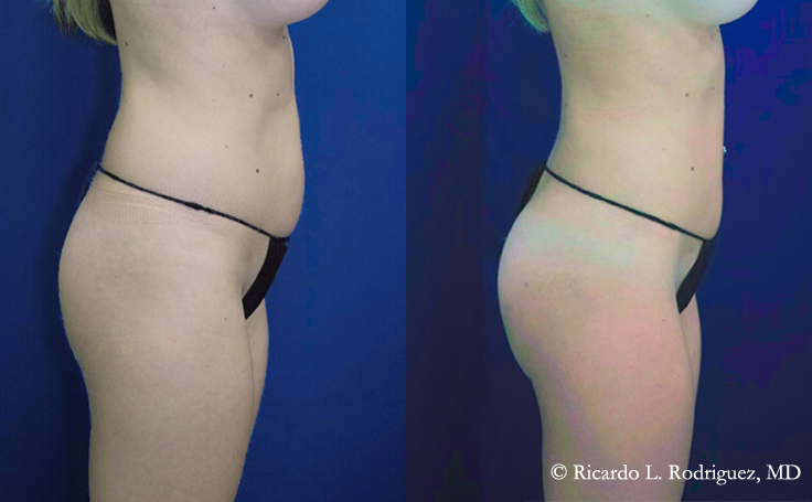 Before and after photo of an actual Brazilian Butt Lift patient.