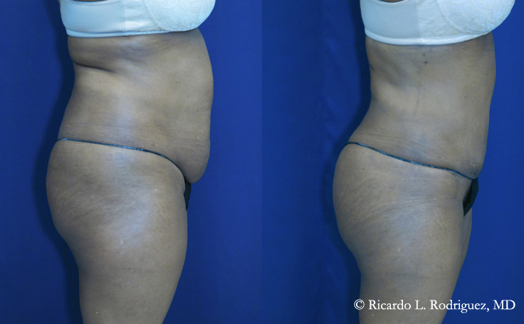 Before and after photo of an actual Brazilian Butt Lift patient.