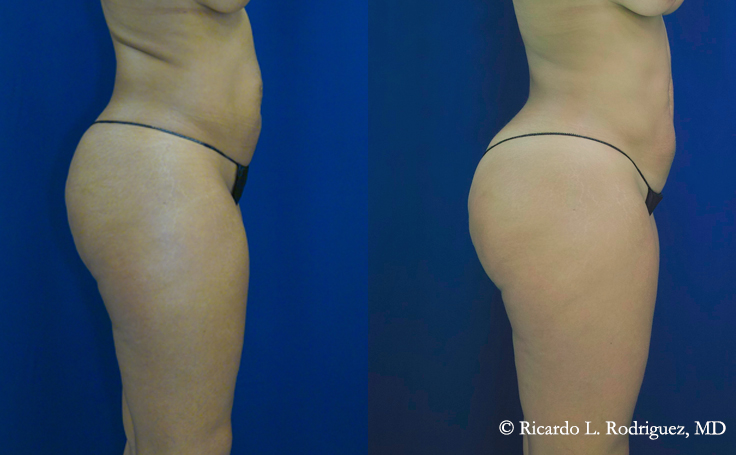 pictures of a brazilian butt lift patient before and after surgery