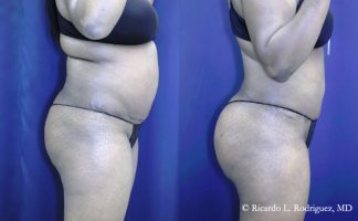 Before and after photo of an actual Brazilian Butt Lift patient.