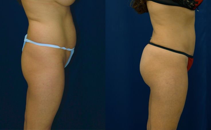 Before and after photo of an actual Brazilian Butt Lift patient.