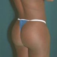 A photo of a female patient, zoomed in from behind, showing the results of a Brazilian butt lift and Tummy tuck combination.