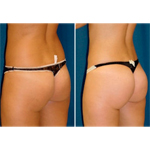 A collage of photos of a patient before & after a Brazilian butt lift.