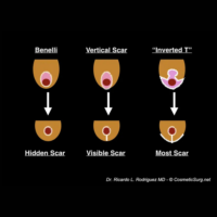 breast lift scar chart illustration by Dr. Ricardo Rodriguez