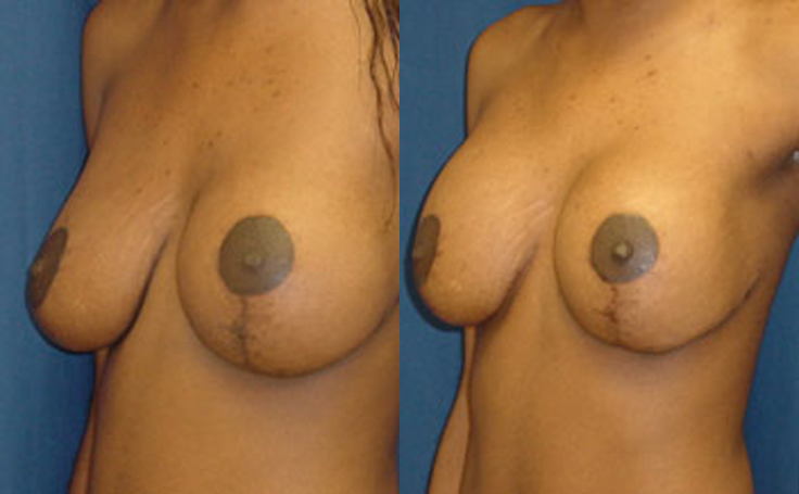 Before & After Breast lift with 600cc implants - Dr. Rodriguez, Cosmeti...