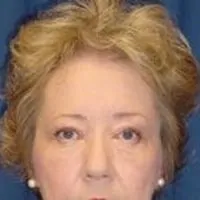 A frontal photo of a woman's face, showing the result of a brow lift.