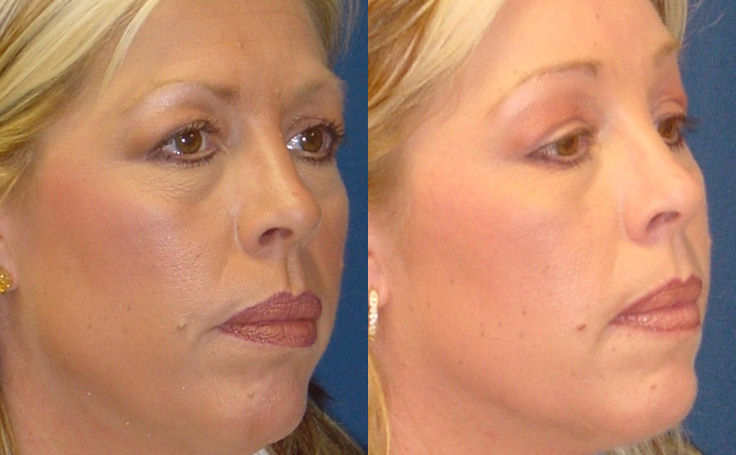 Before and after photo of an actual Brow Lift patient.