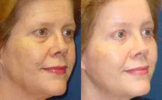 Before and after photo of an actual Brow Lift patient.