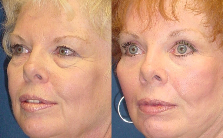 Before and after photo of an actual Brow Lift patient.