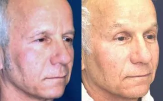 Before and after photo of an actual Brow Lift patient.