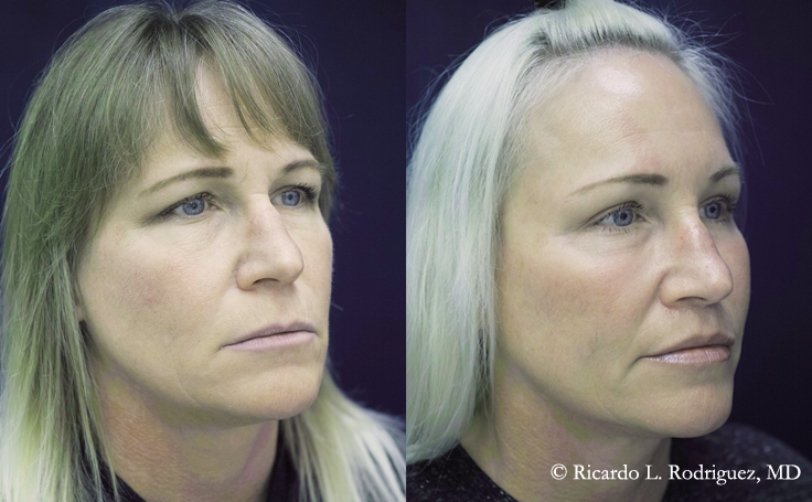 Before and after photo of an actual Brow Lift patient.