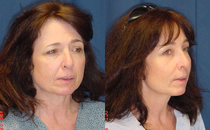 Before and after photo of an actual Brow Lift patient.