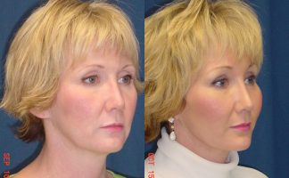 Before and after photo of an actual Brow Lift patient.