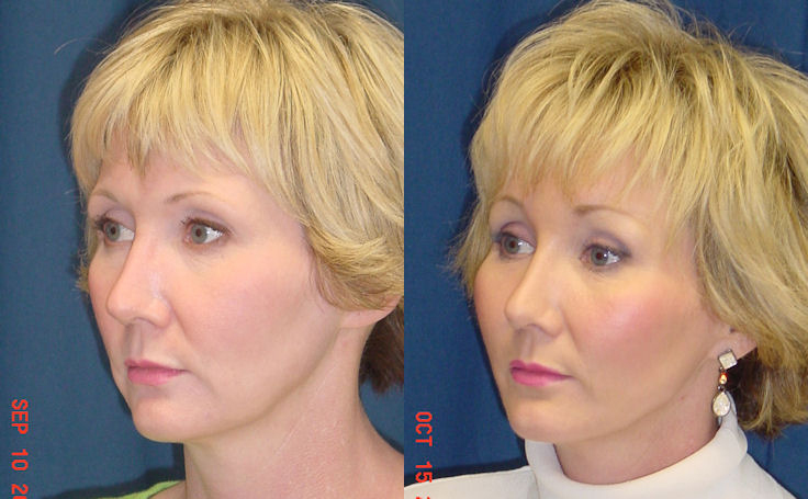 Before and after photo of an actual Brow Lift patient.