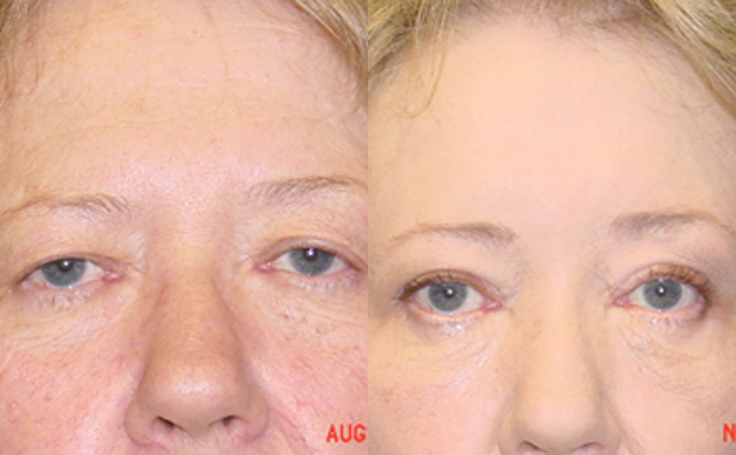 Before and after photo of an actual Brow Lift patient.