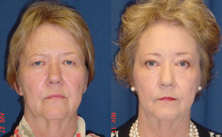 Before and after photo of an actual Brow Lift patient.