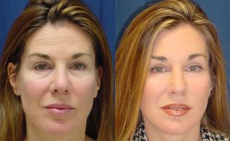 Before and after photo of an actual Brow Lift patient.