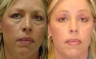 Before and after photo of an actual Brow Lift patient.