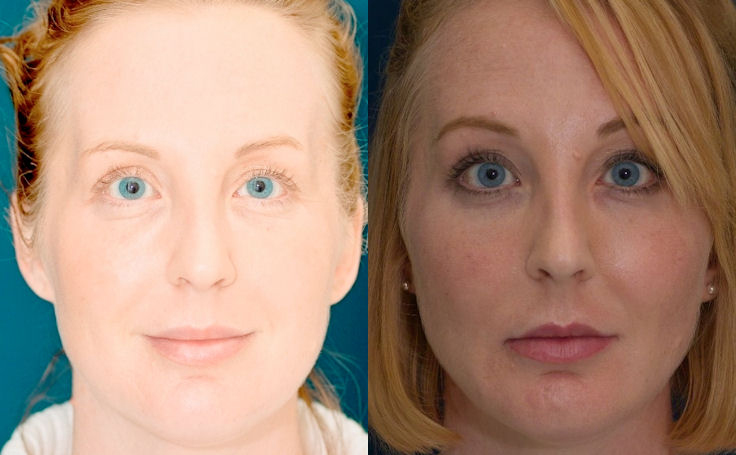 Before and after photo of an actual Brow Lift patient.