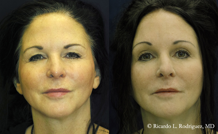 Before and after photo of an actual Brow Lift patient.