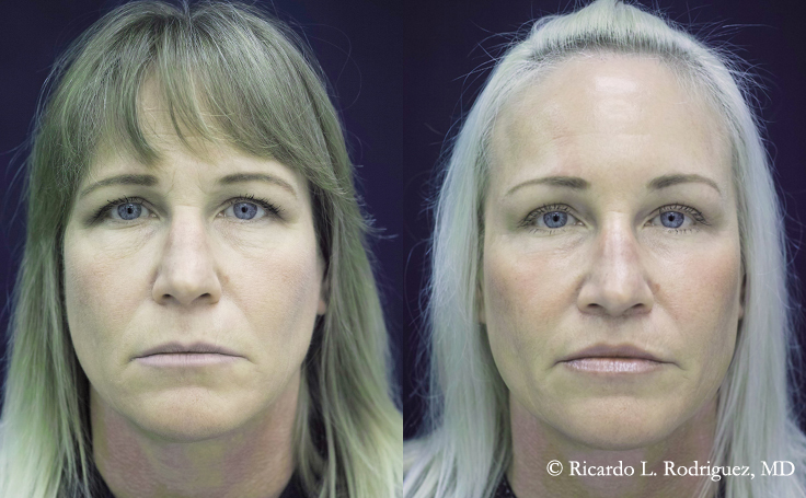 Before and after photo of an actual Brow Lift patient.