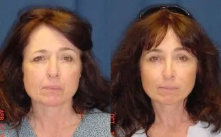 Before and after photo of an actual Brow Lift patient.