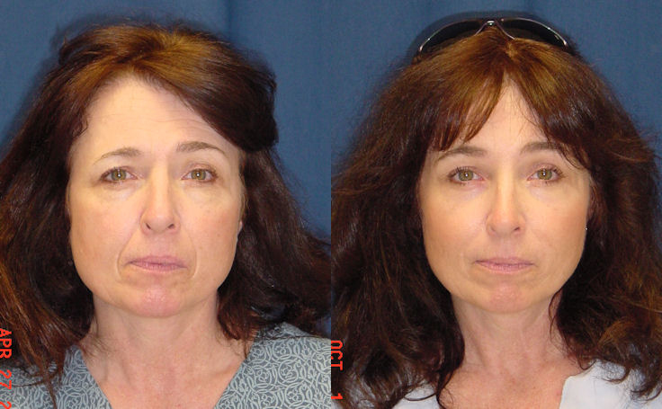 Before and after photo of an actual Brow Lift patient.