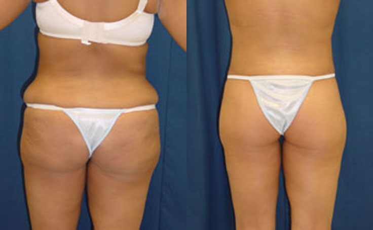 Before and after photo of an actual Butt Lift (skin tightening) patient.