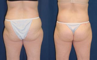 Before and after photo of an actual Butt Lift (skin tightening) patient.