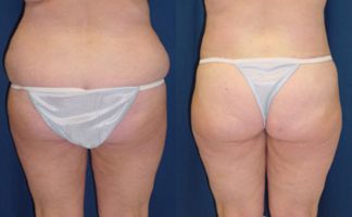 Before and after photo of an actual Butt Lift (skin tightening) patient.
