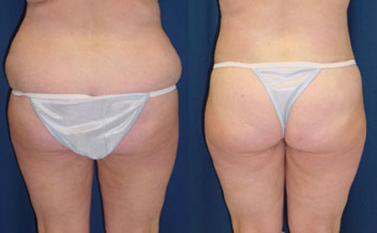 Before and after photo of an actual Butt Lift (skin tightening) patient.