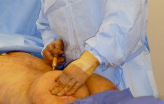 Dr. Ricaro L. Rodriguez performing brazilian butt lift fat injections.