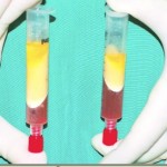 2 syringes with centrifuged fat.
