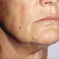 A photo of a patient's face, showing her lips before a lip lift.