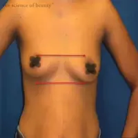mild breast asymmetry patient diagram