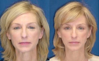 Before and after photo of an actual Eyelid Surgery patient.