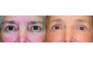 Before and after photo of an actual Eyelid Surgery patient.